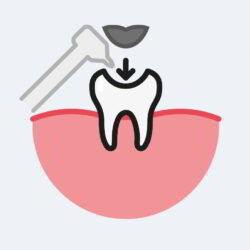 Dental Fillings