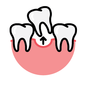 Synergy Dental Extraction