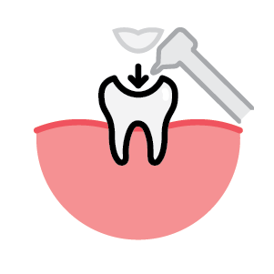 Inlays Dental Fillings