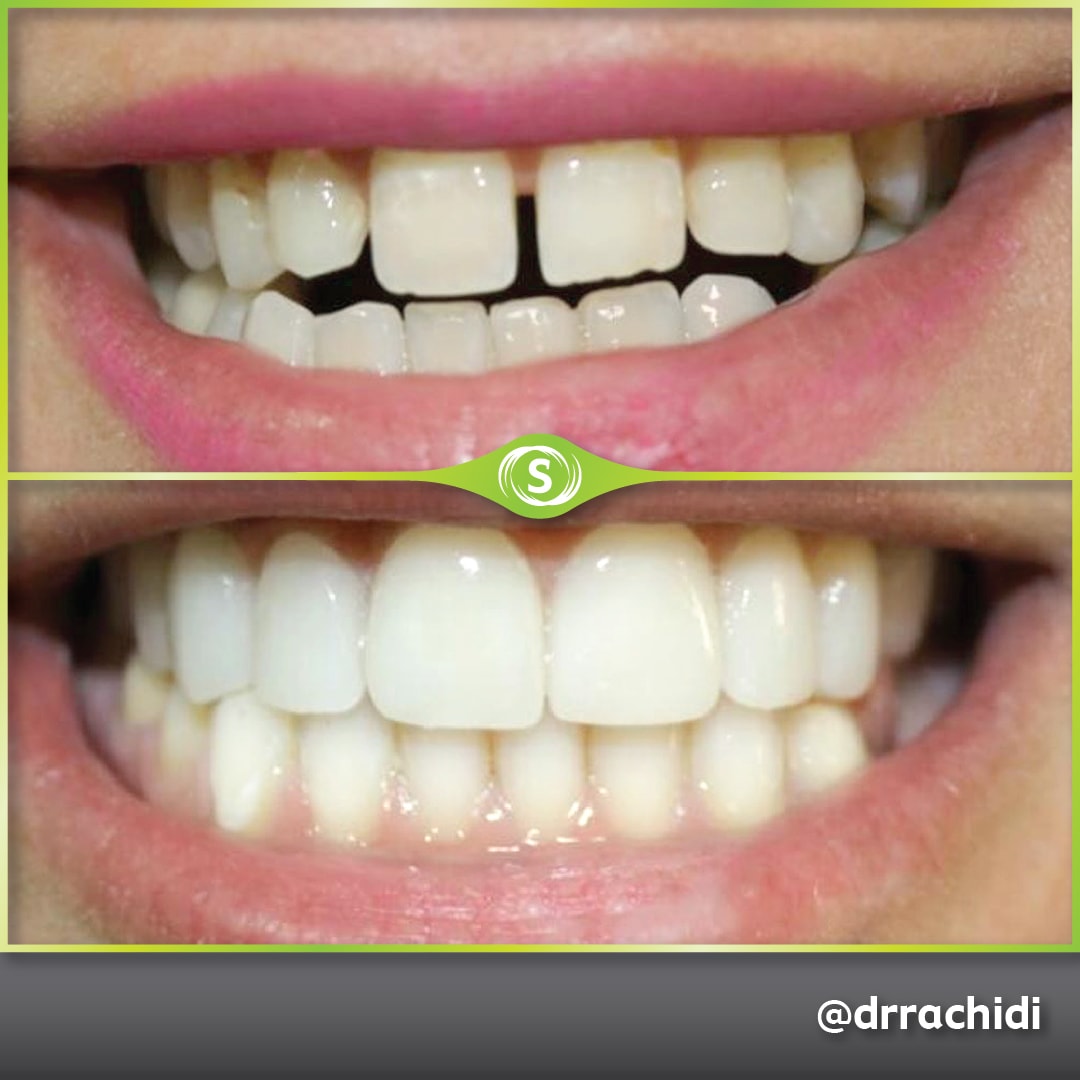 Dental Veneers E-max Zirconia - Dr. Karim Rachidi