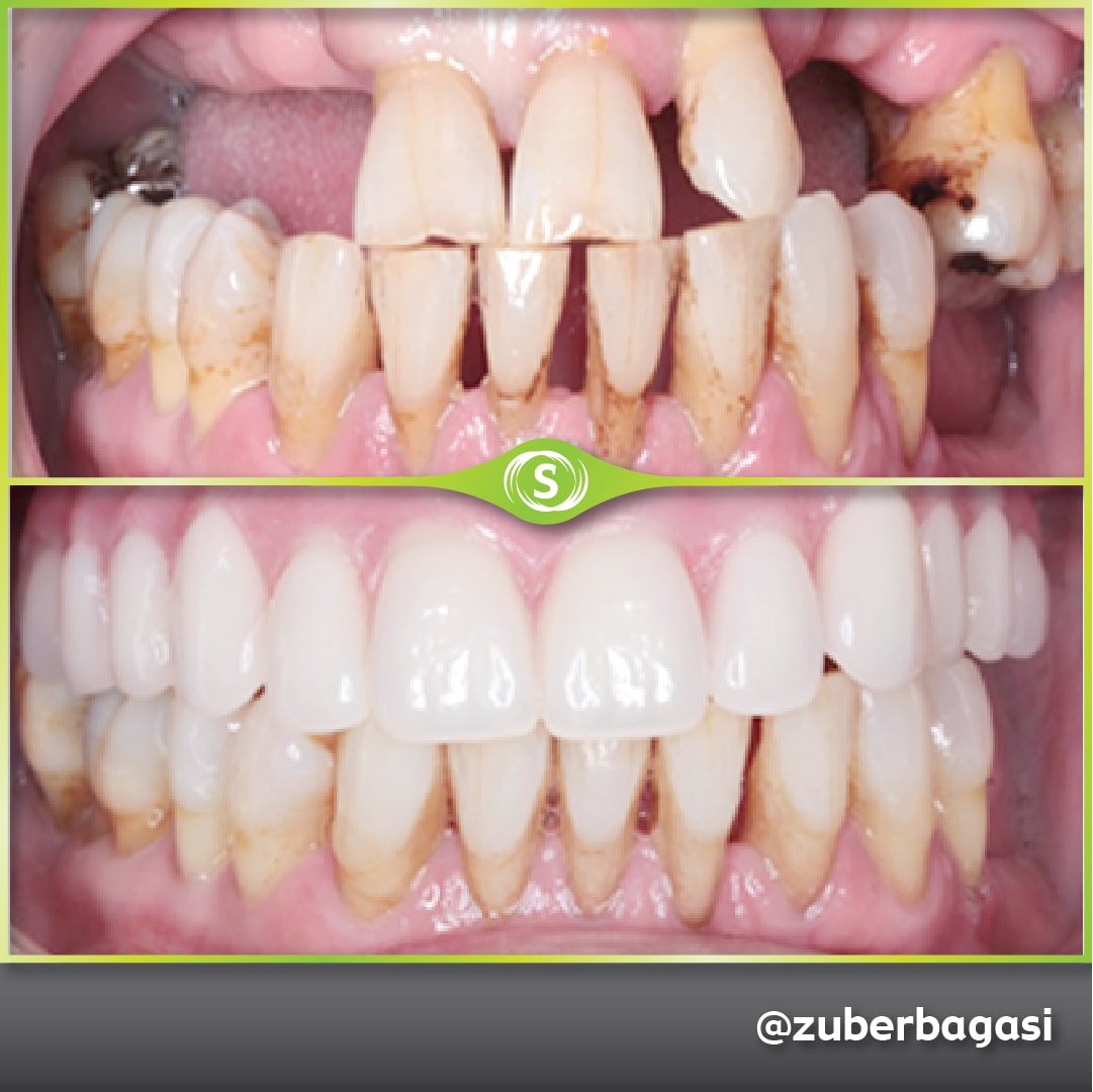 B&A FSD Implants ZB 4b-min