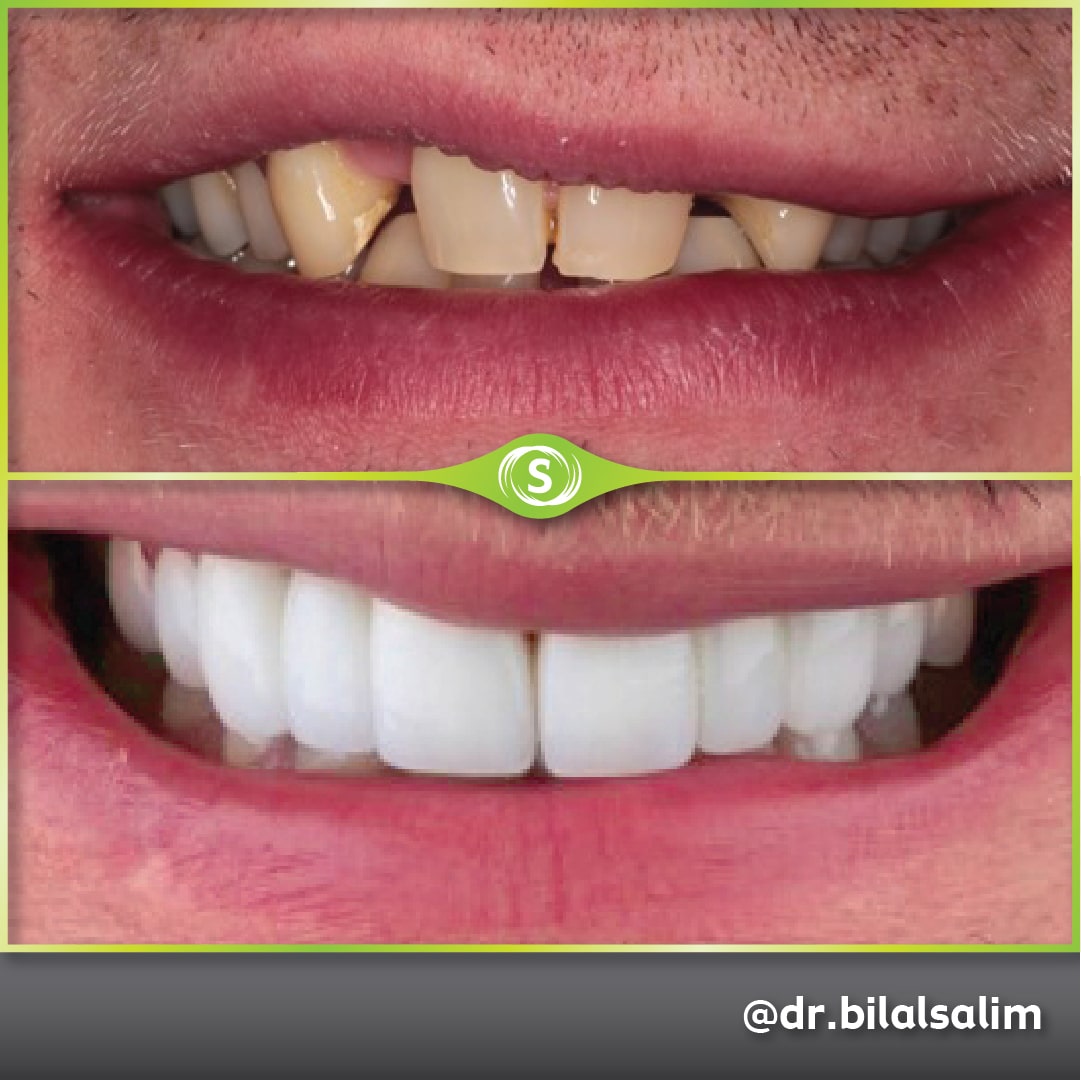 B&A Bridges Veneers BS 1a-min