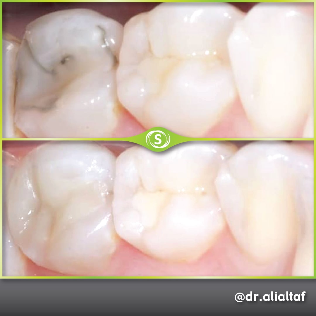B&A Comp Bonding AA 2-min (1)