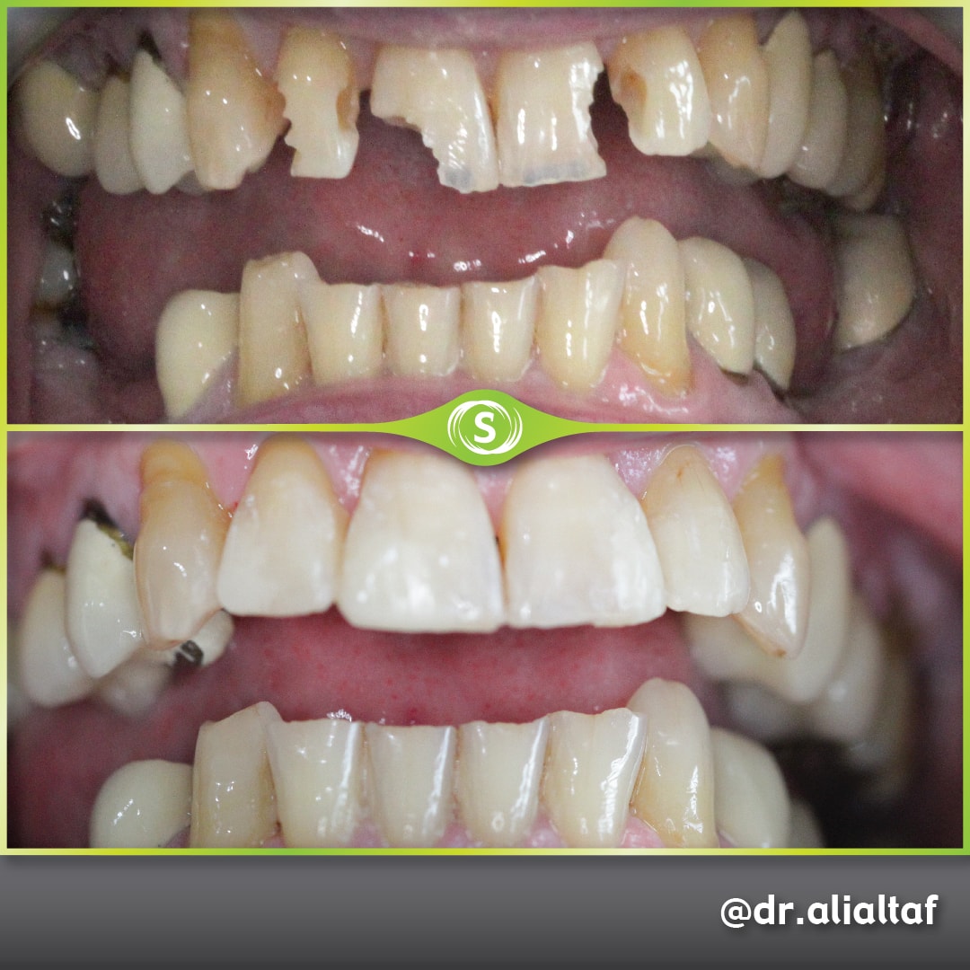 Composite Bonding - Dr. Ali Altaf