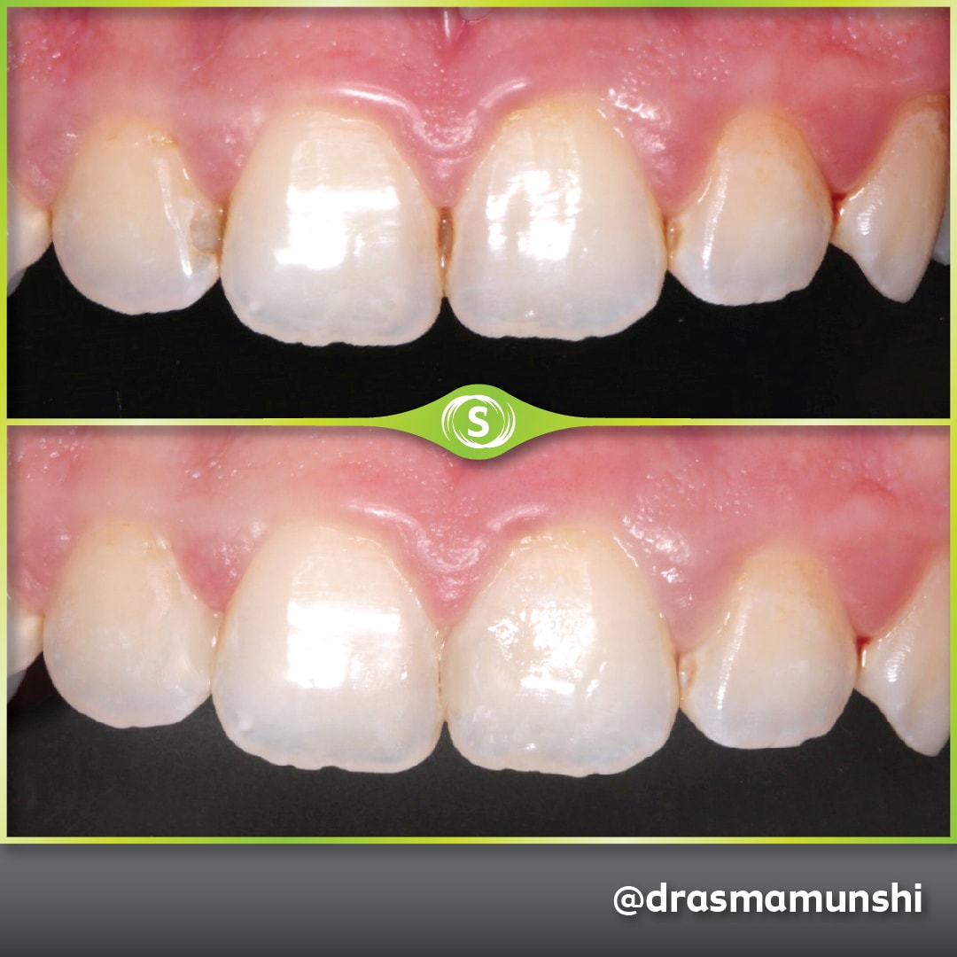 Composite Bonding - Dr. Asma Valli