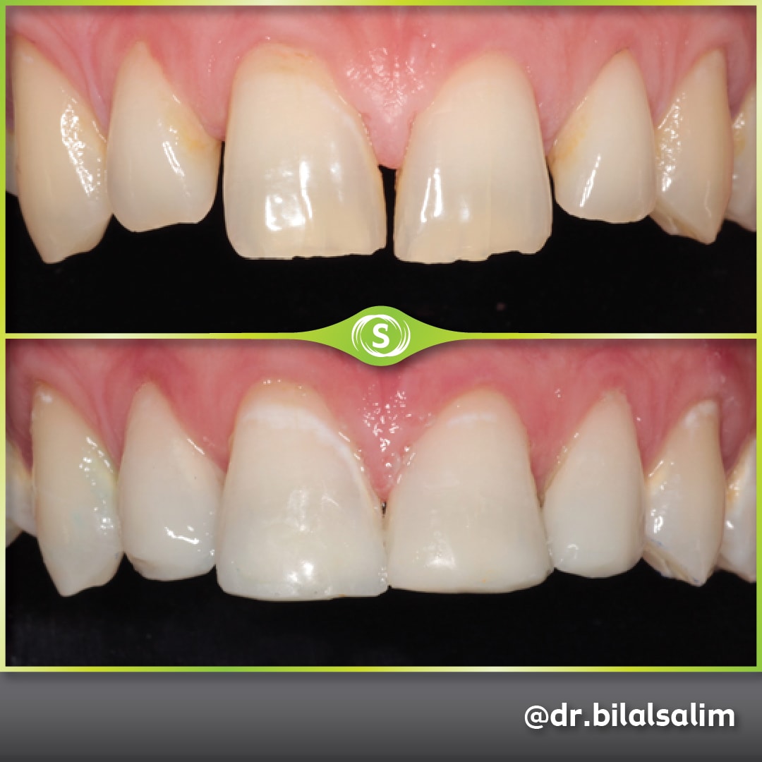 Composite Bonding - Dr. Bilal Salim