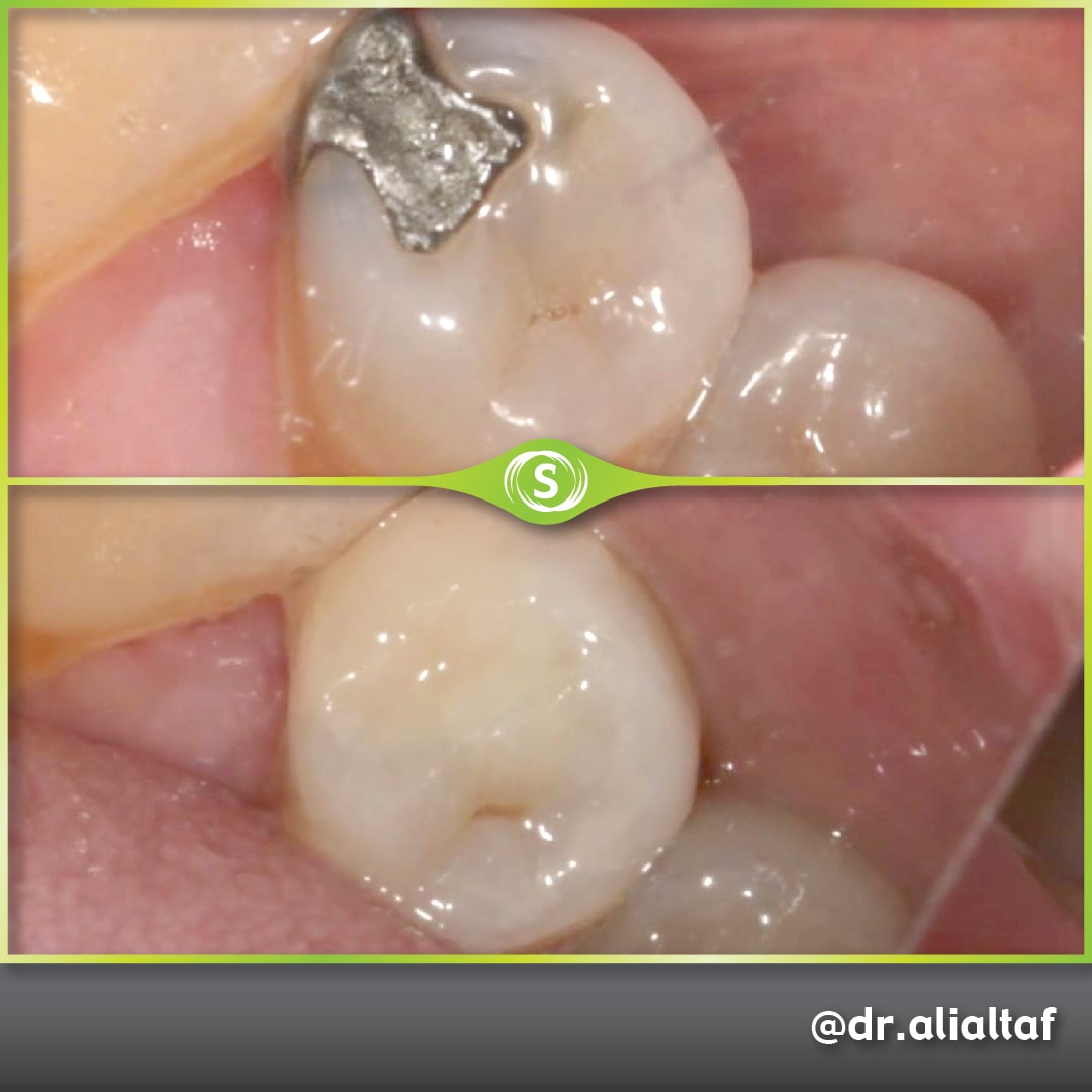 Composite Filling - Dr. Ali Altaf