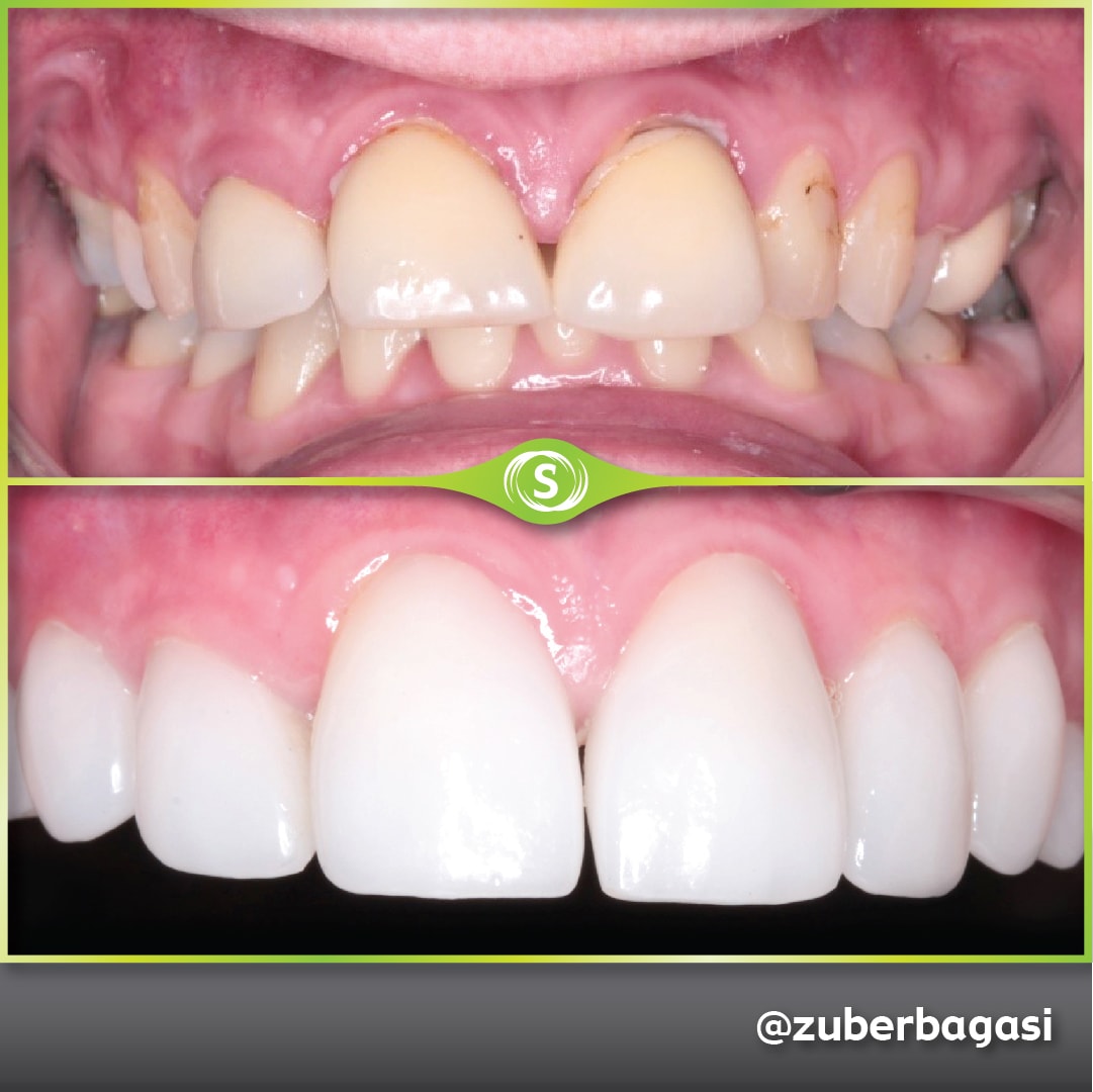 B&A Emax Veneers ZB 1-min