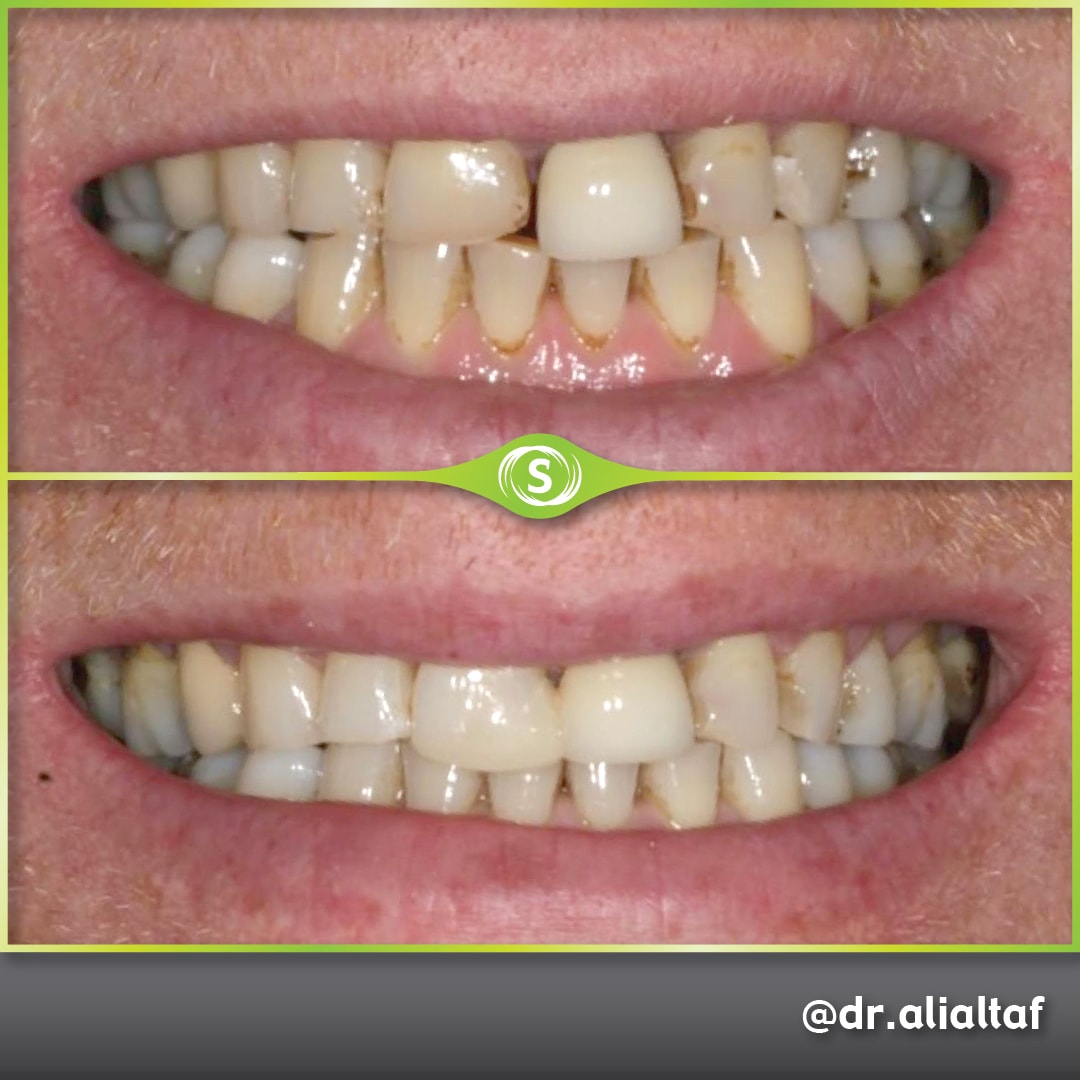 Composite Bonding - Dr. Ali Altaf