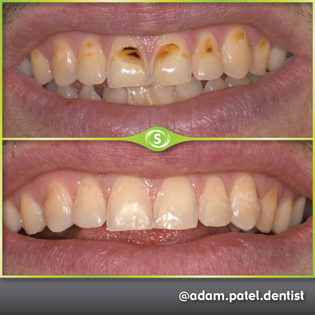 Composite Bonding - Adam Patel