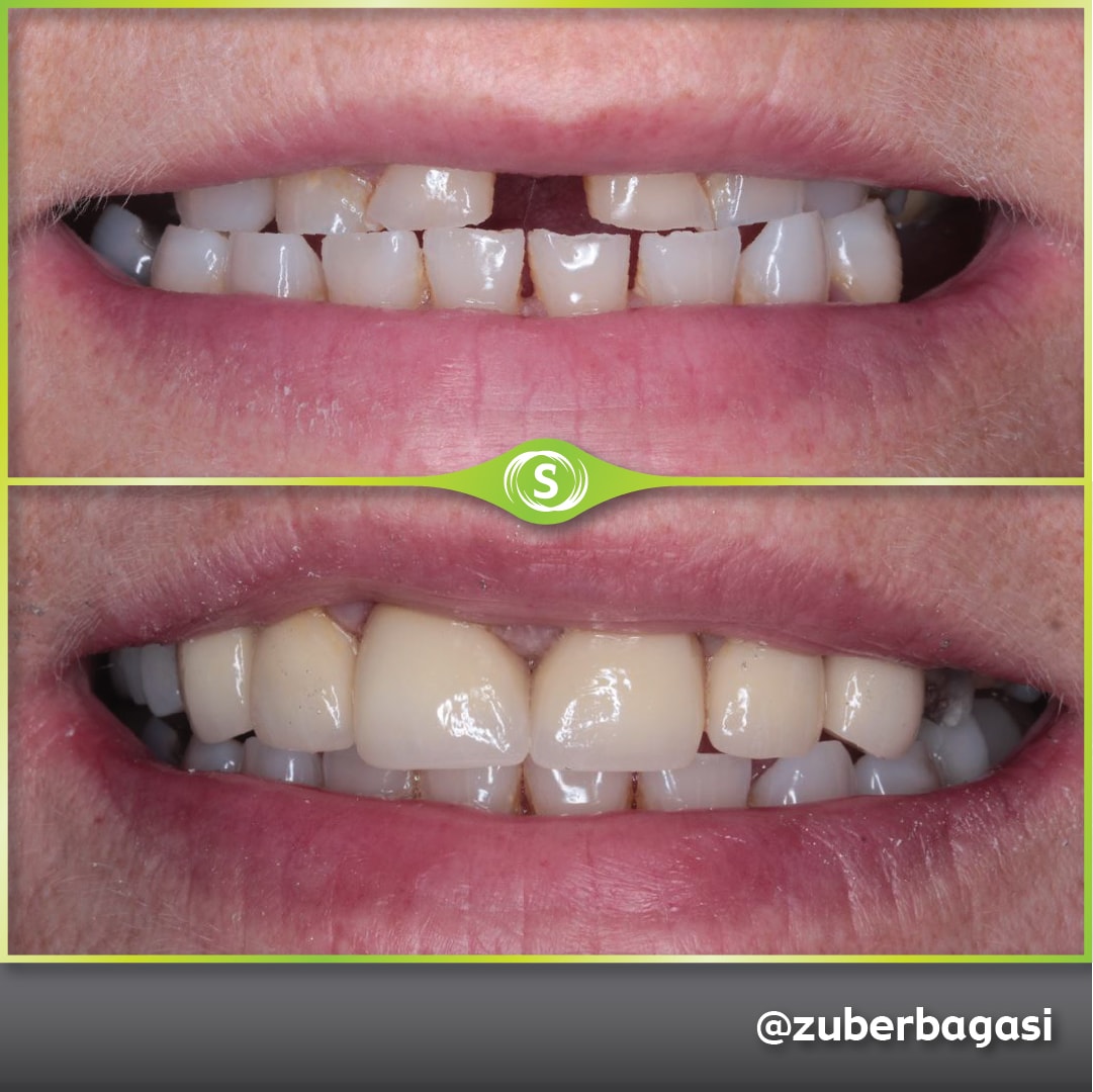 B&A Emax Crowns ZB 5-min