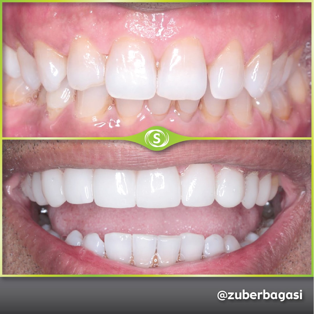 B&A Emax Veneers ZB 2-min