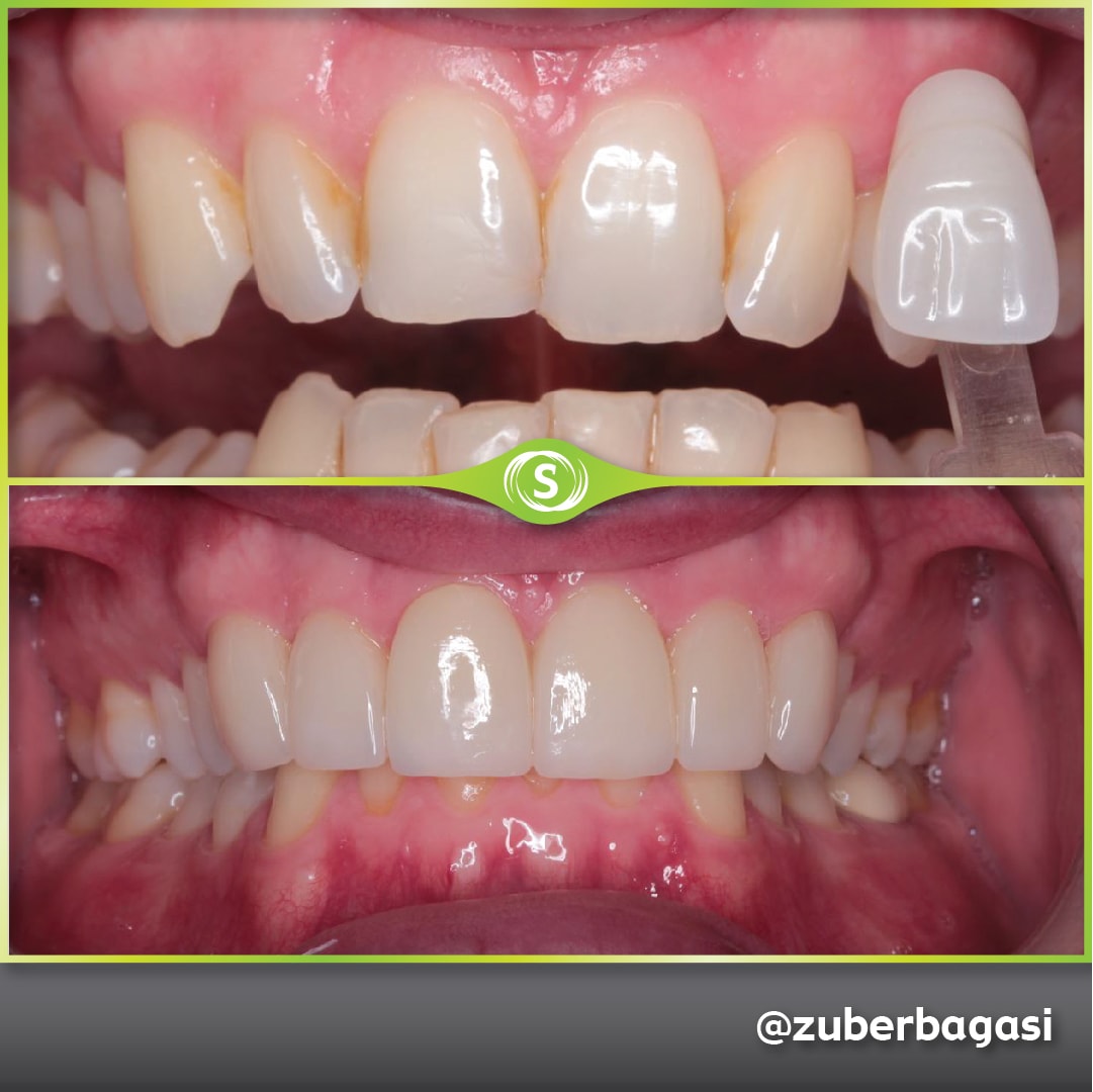 B&A Emax Veneers ZB 3-min