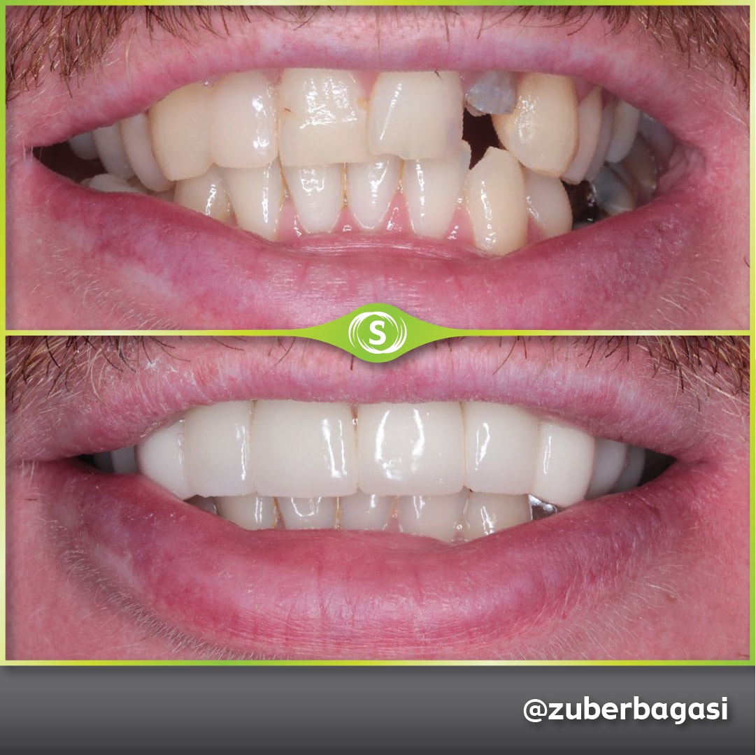 B&A Zirconia Bridge ZB 2-min
