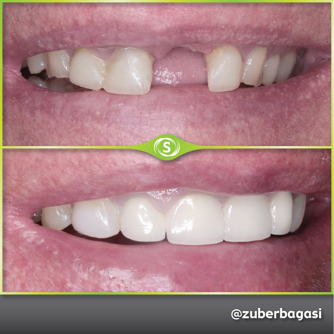 B&A Zirconia Bridge ZB 3-min