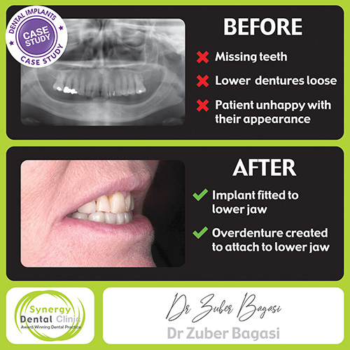 Implant Retained Overdentures BEFORE & AFTER CASE STUDY