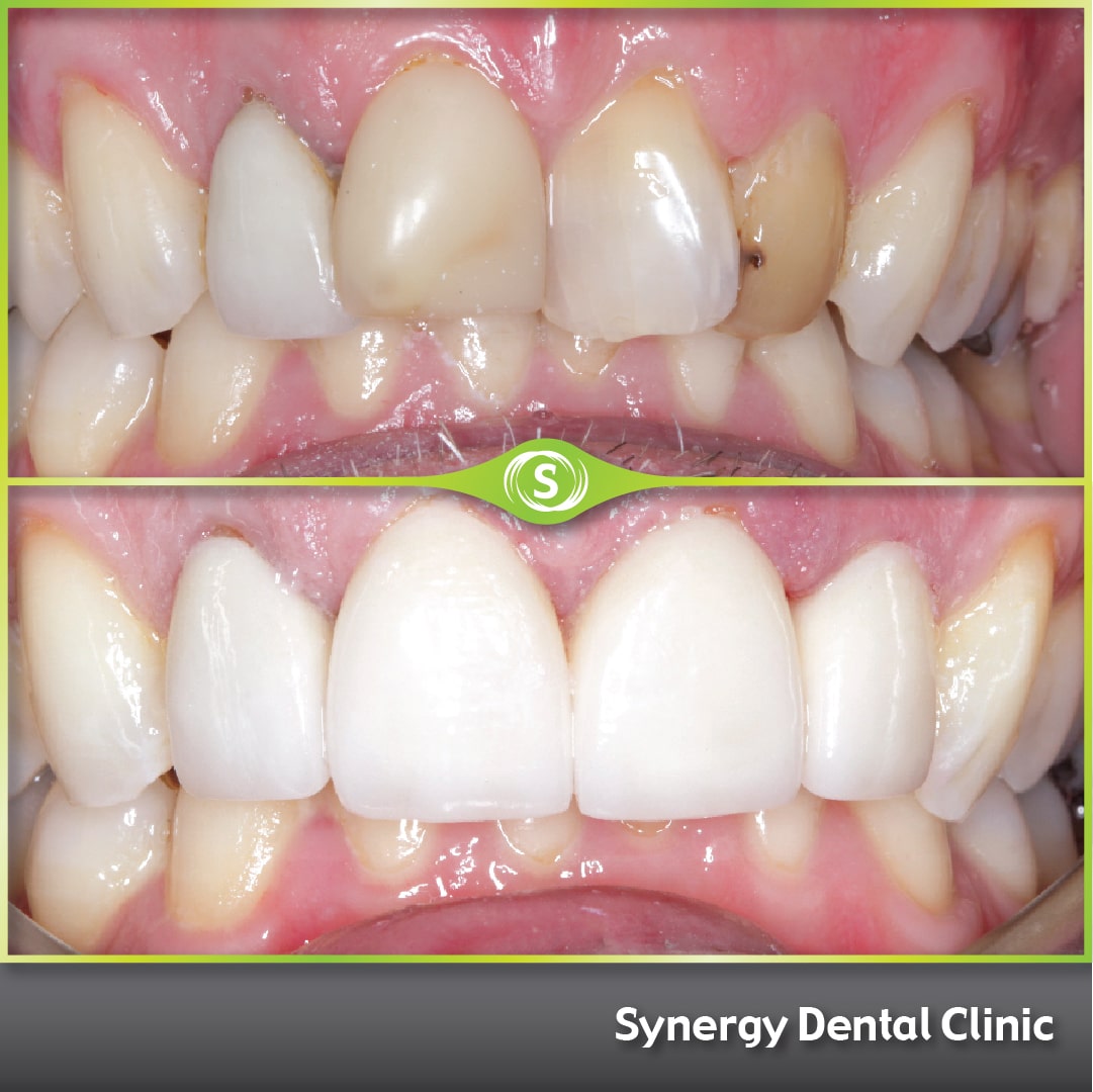 B&A Invisalign SDC 2-min (1)