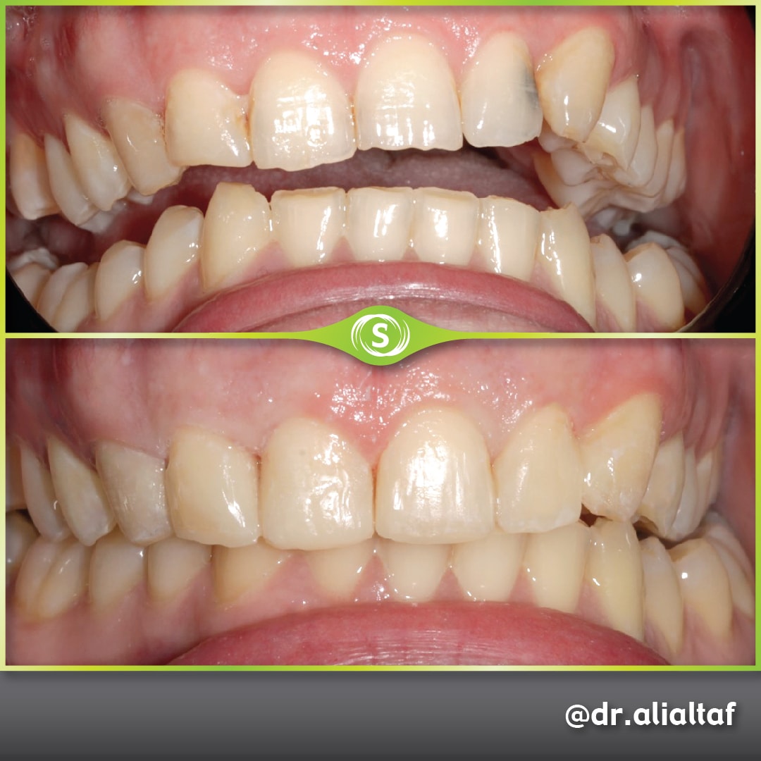 Composite Bonding - Dr. Ali Altaf