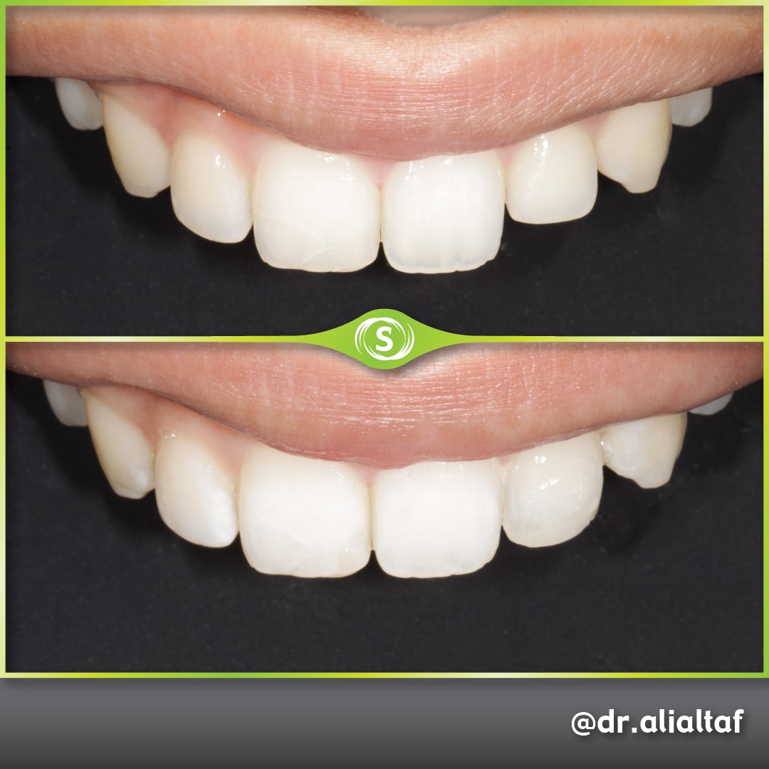 Composite Bonding - Dr. Ali Altaf