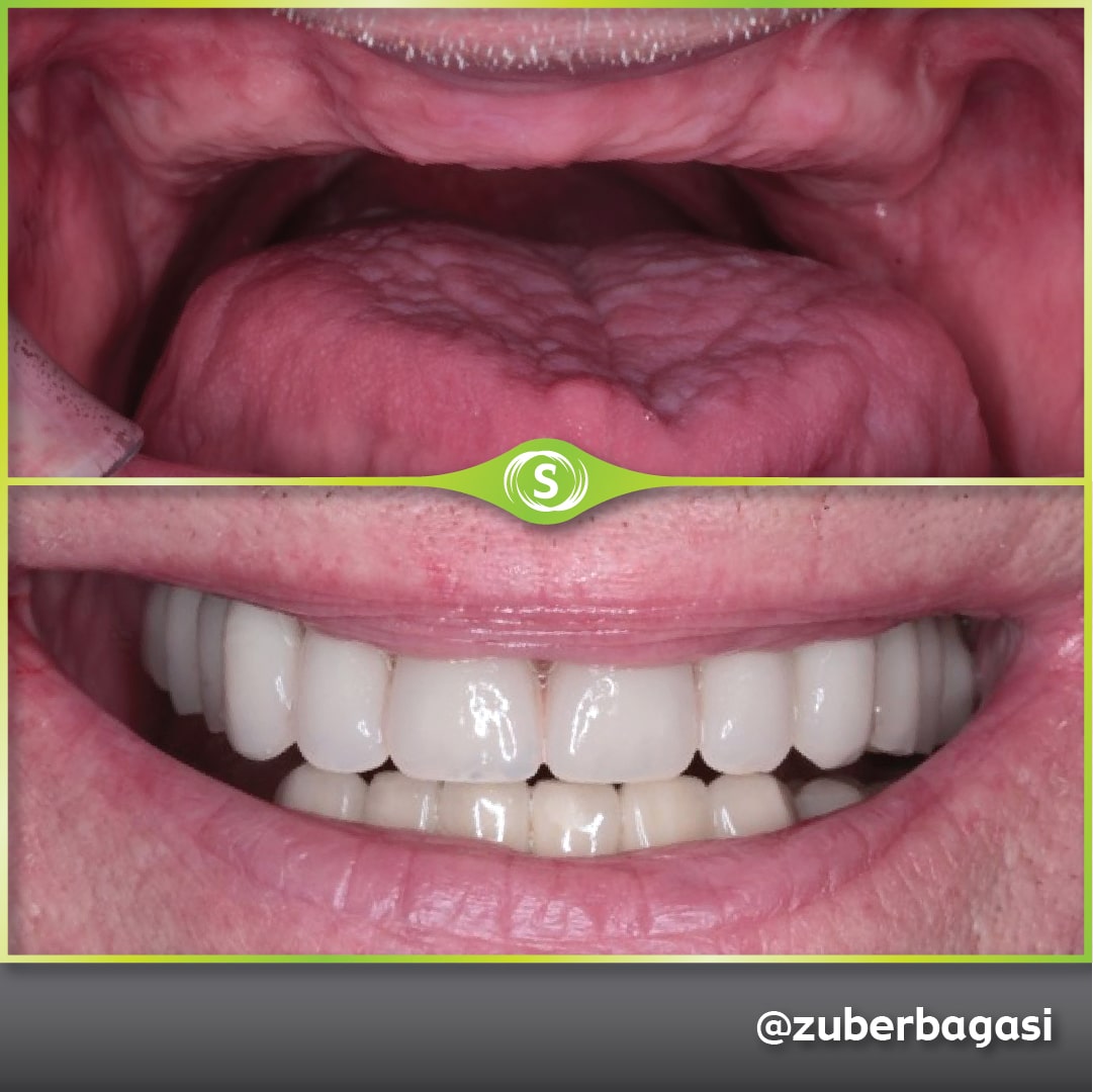B&A FSD Implants ZB 5b-min