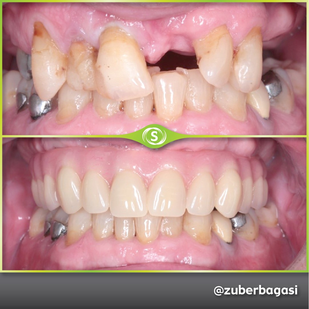 Full Same Day implants - Dr. Zuber Bagasi