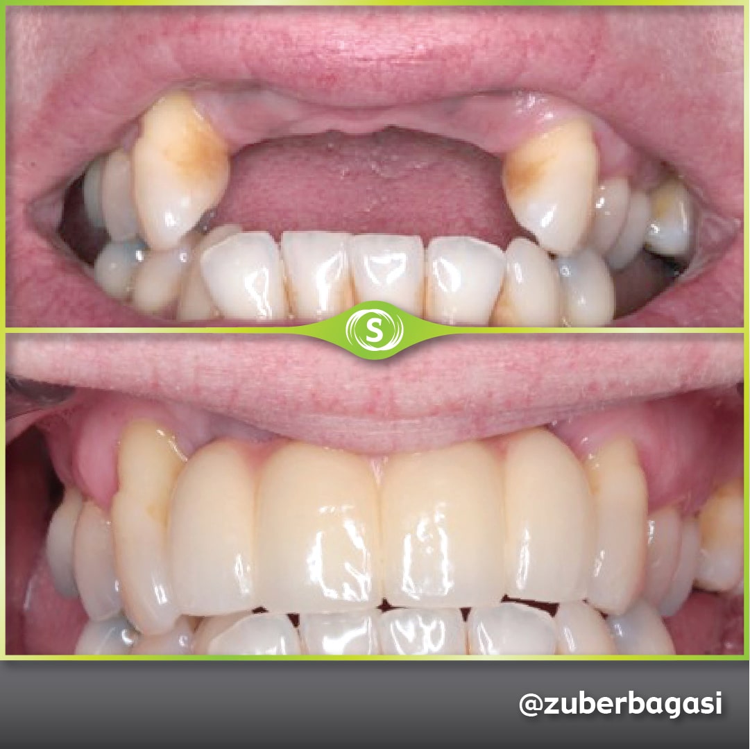 Case Study Dental Implants - 4 Unit Bridge