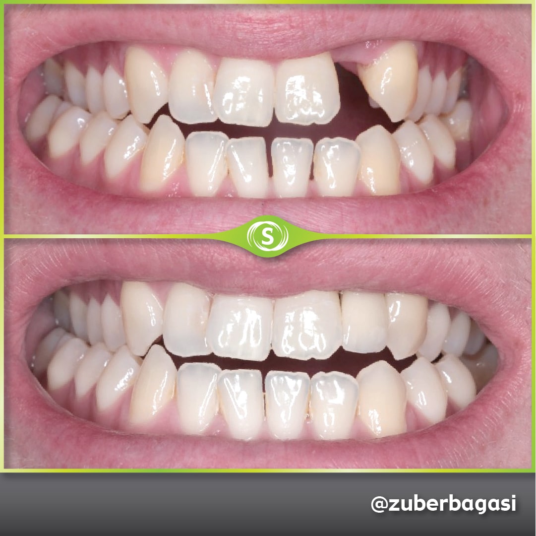 B&A Implants ZB 4-min