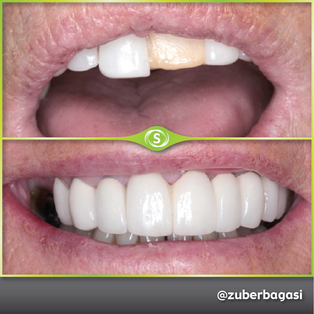 B&A Implants ZB 6b-min (1)