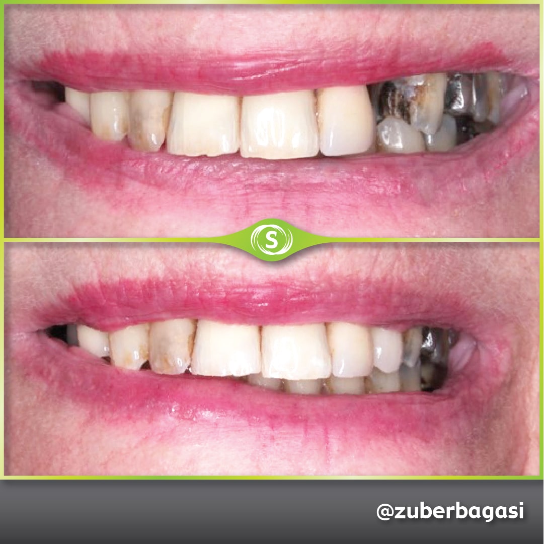 B&A Implants ZB 7-min