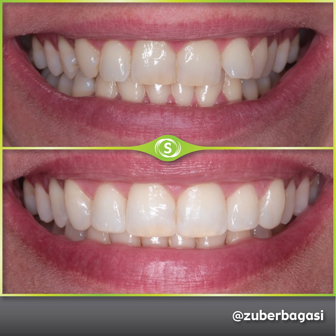 B&A Invisalign ZB 1-min (1)