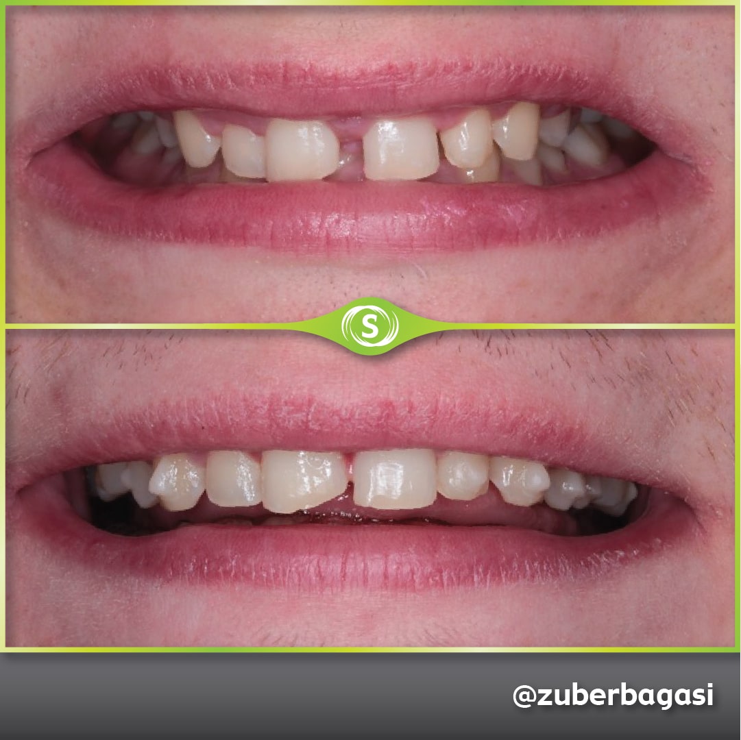 B&A Invisalign ZB 11-min