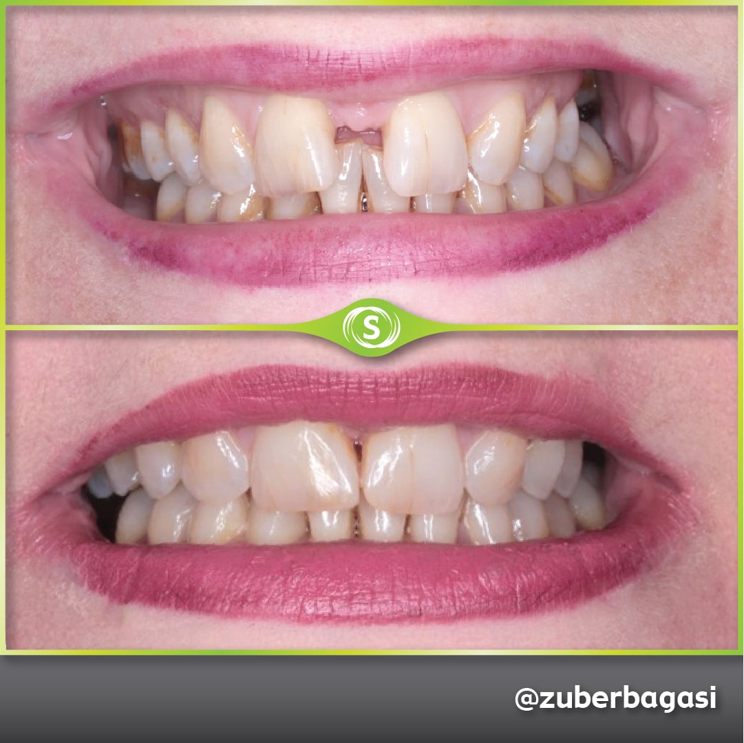B&A Invisalign ZB 4a-min
