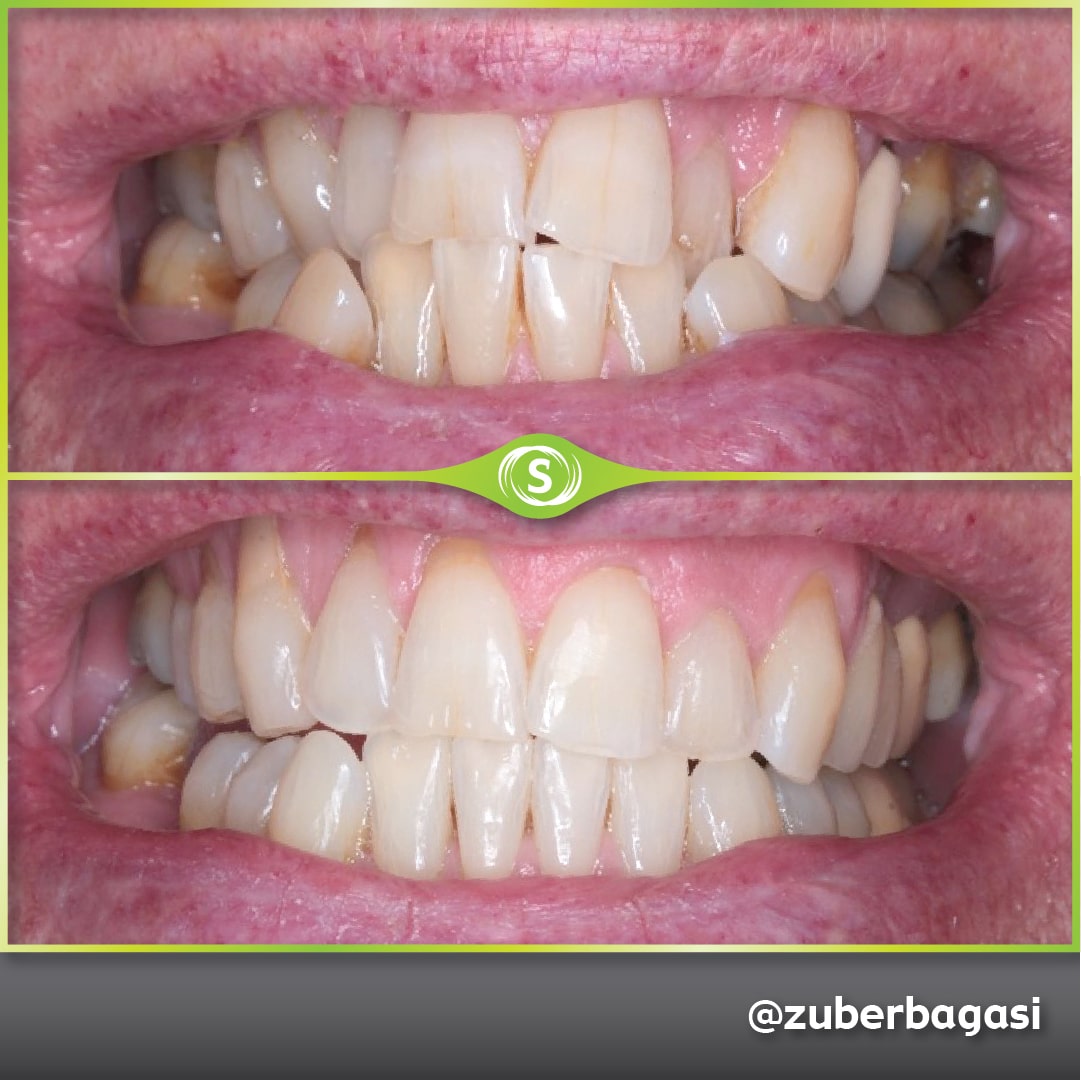 B&A Invisalign ZB 7-min
