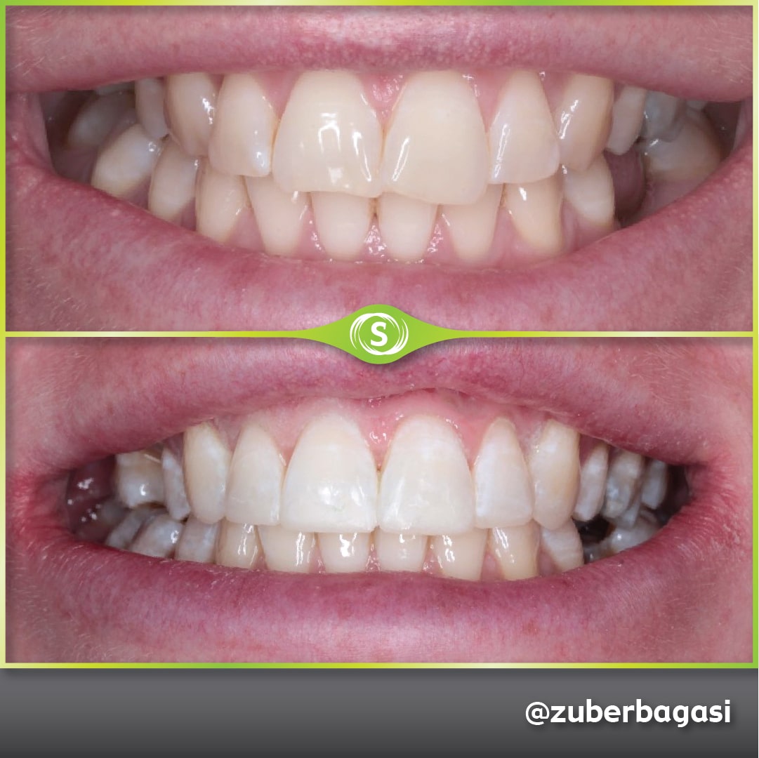 B&A Invisalign ZB 8-min