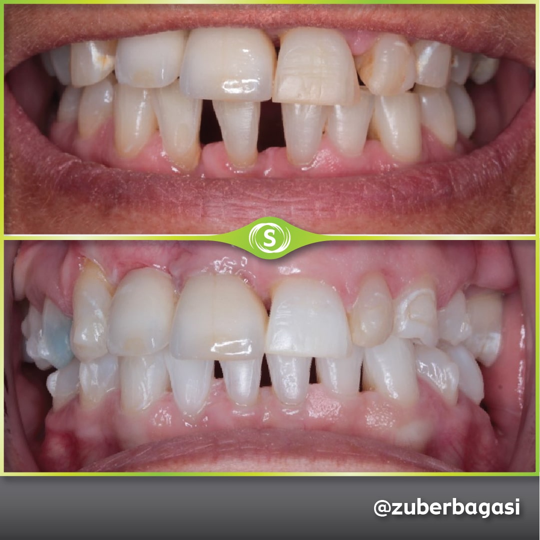 B&A Invisalign ZB 9-min