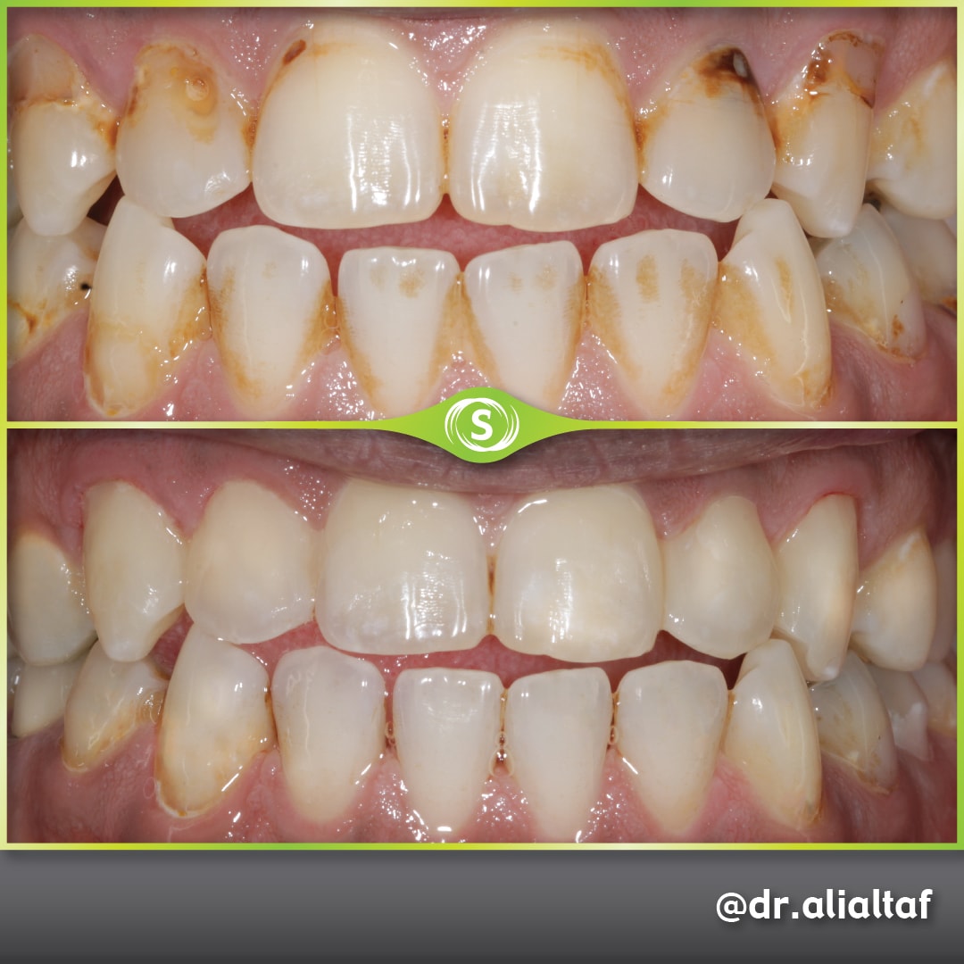 Stain Removal - Dr. Ali Altaf