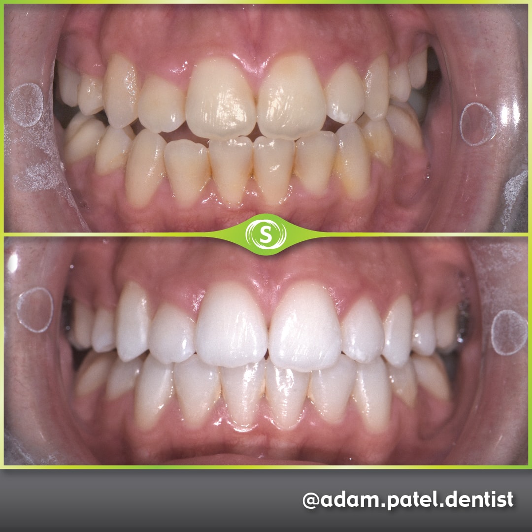 Teeth Whitening - Dr. Adam Patel