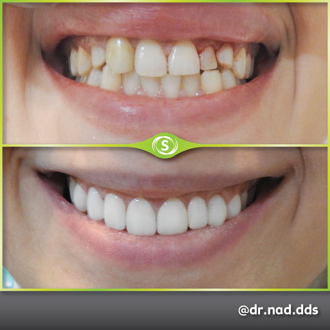 Composite Veneers - Dr. Nader Modarres