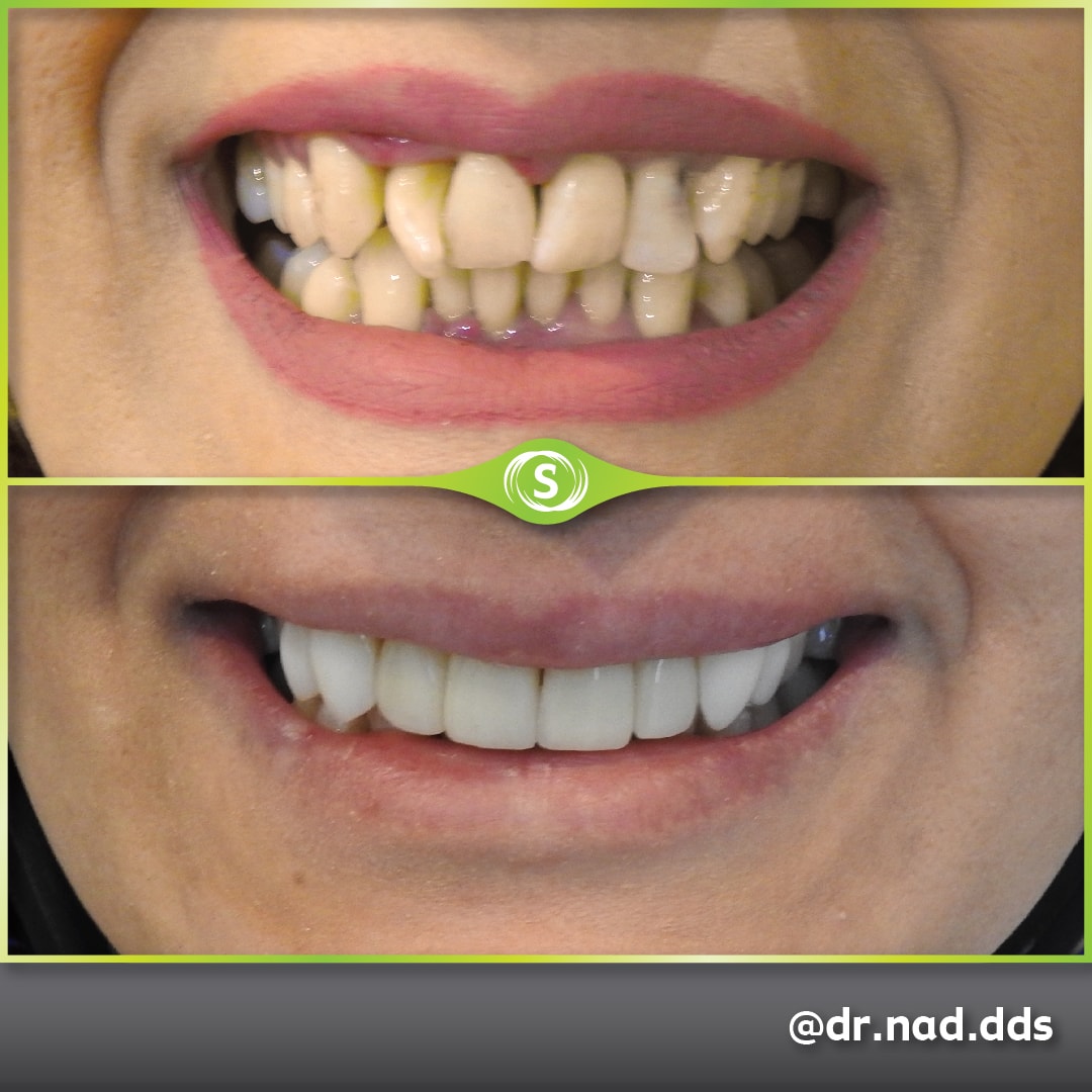 Composite Veneers - Dr. Nader Modarres