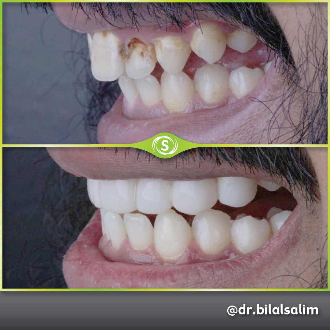 Composite Bonding - Dr. Bilal Salim