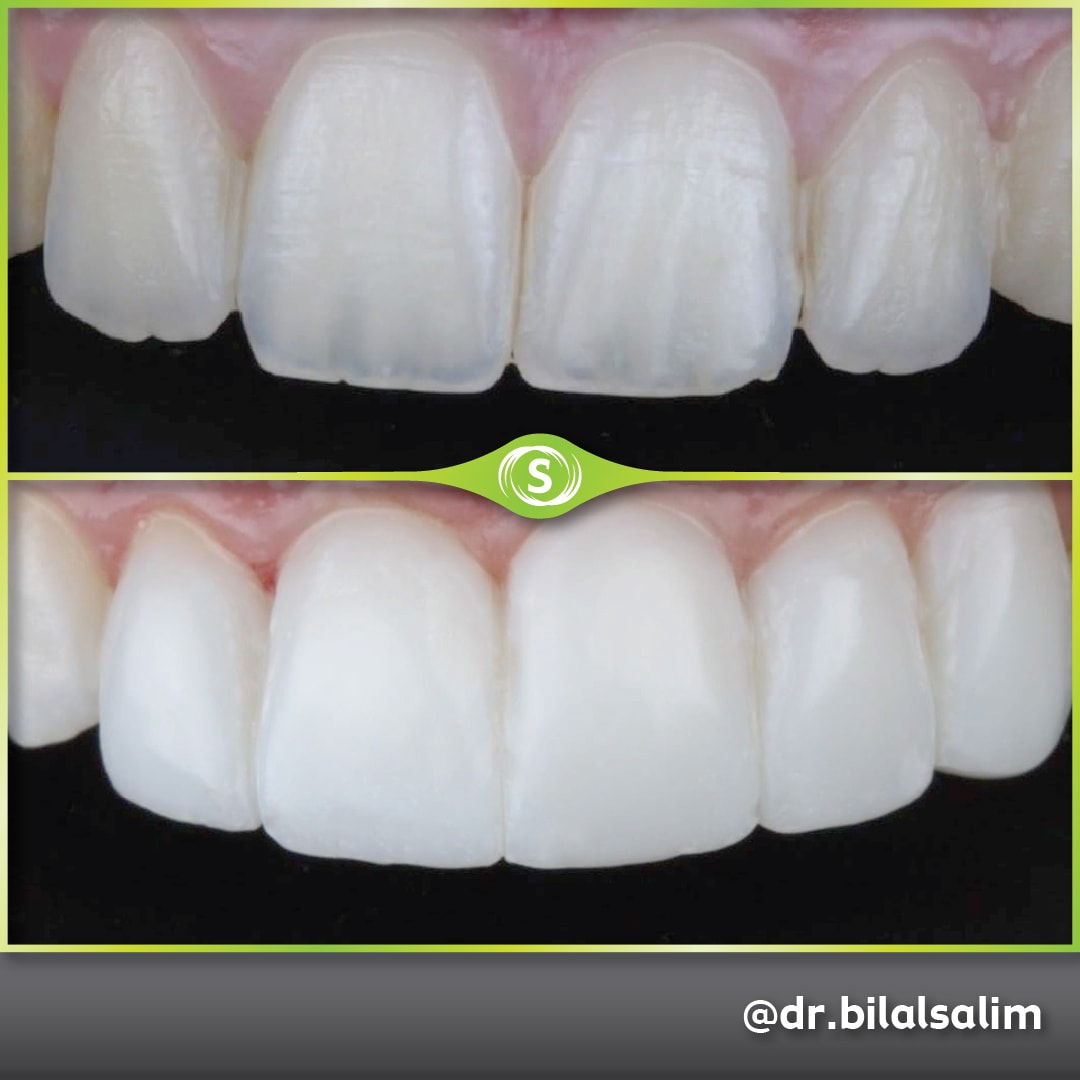 Composite Bonding - Dr. Bilal Salim