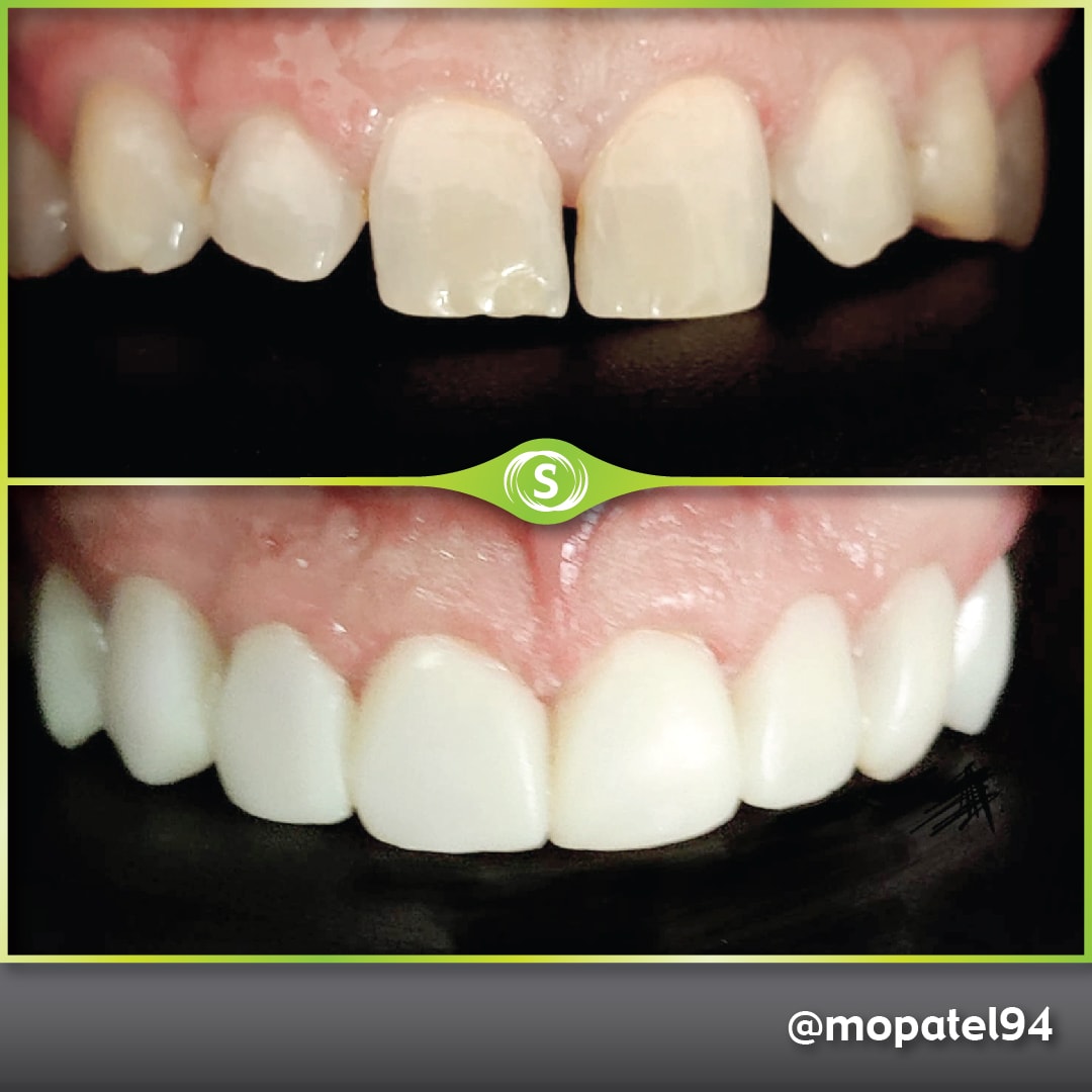 Composite Bonding - Dr. Mo Patel