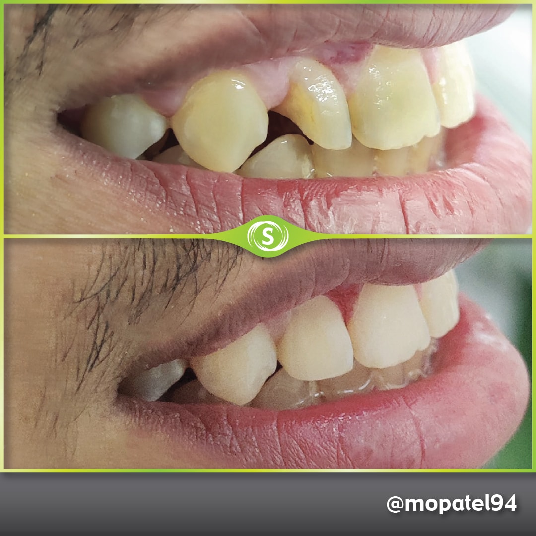 Composite Bonding - Dr. Mo Patel