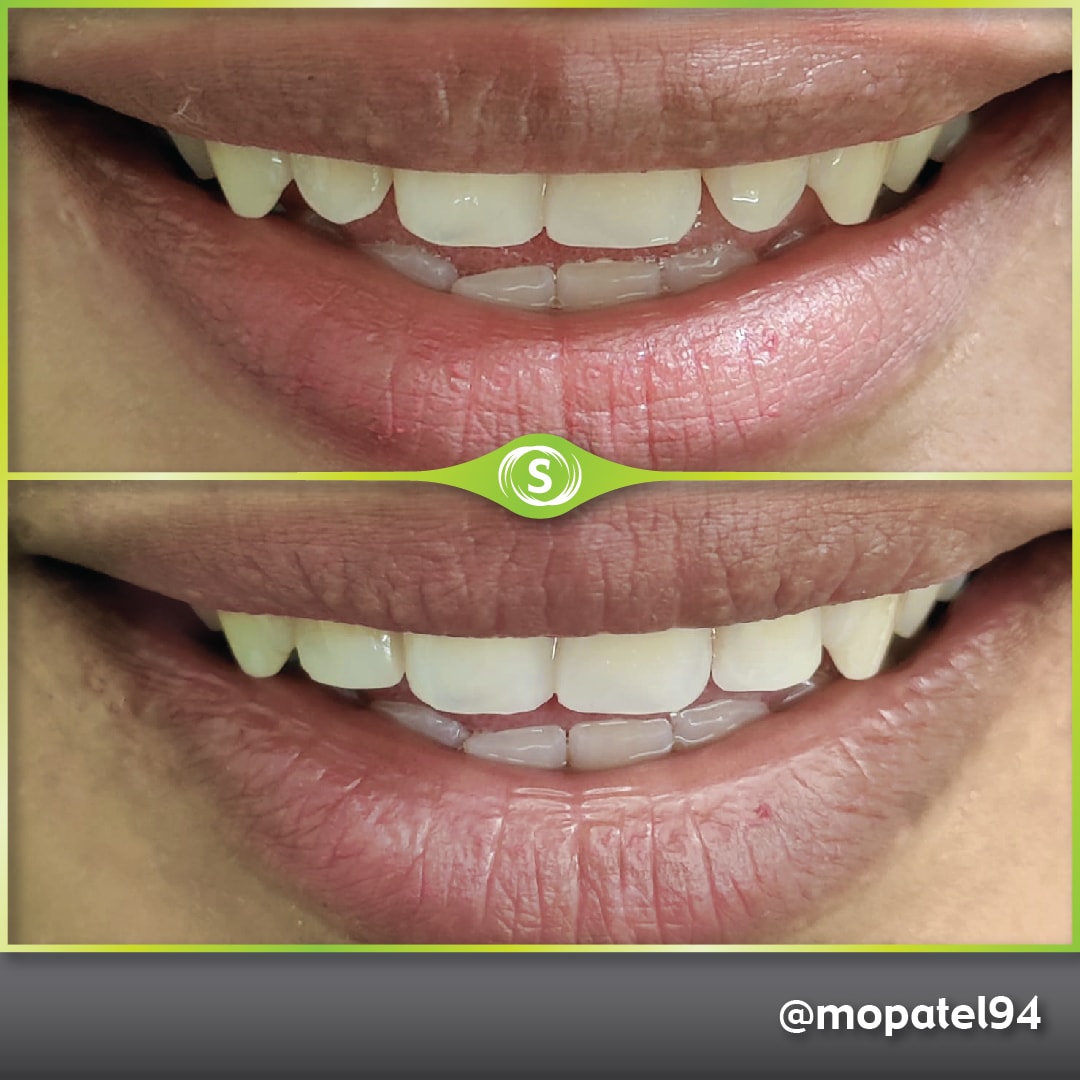 Composite Bonding Dr. Mo Patel