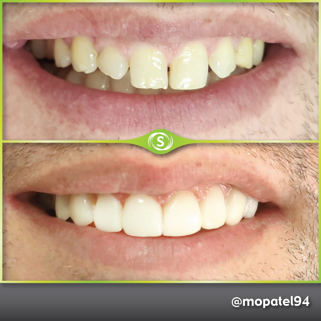 Composite Bonding - Dr. Mo Patel