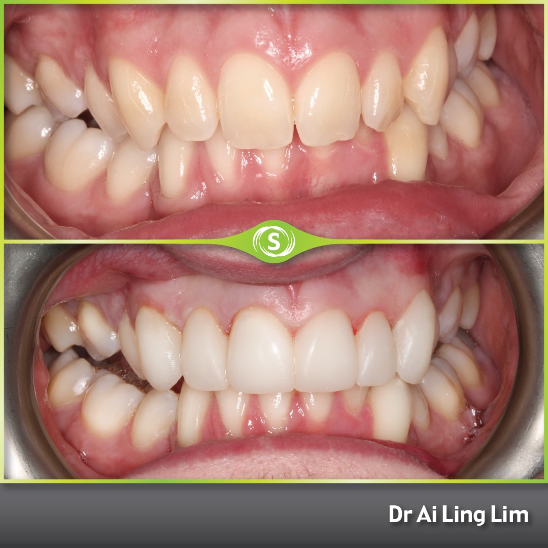 Composite bonding - Ai Ling Lim