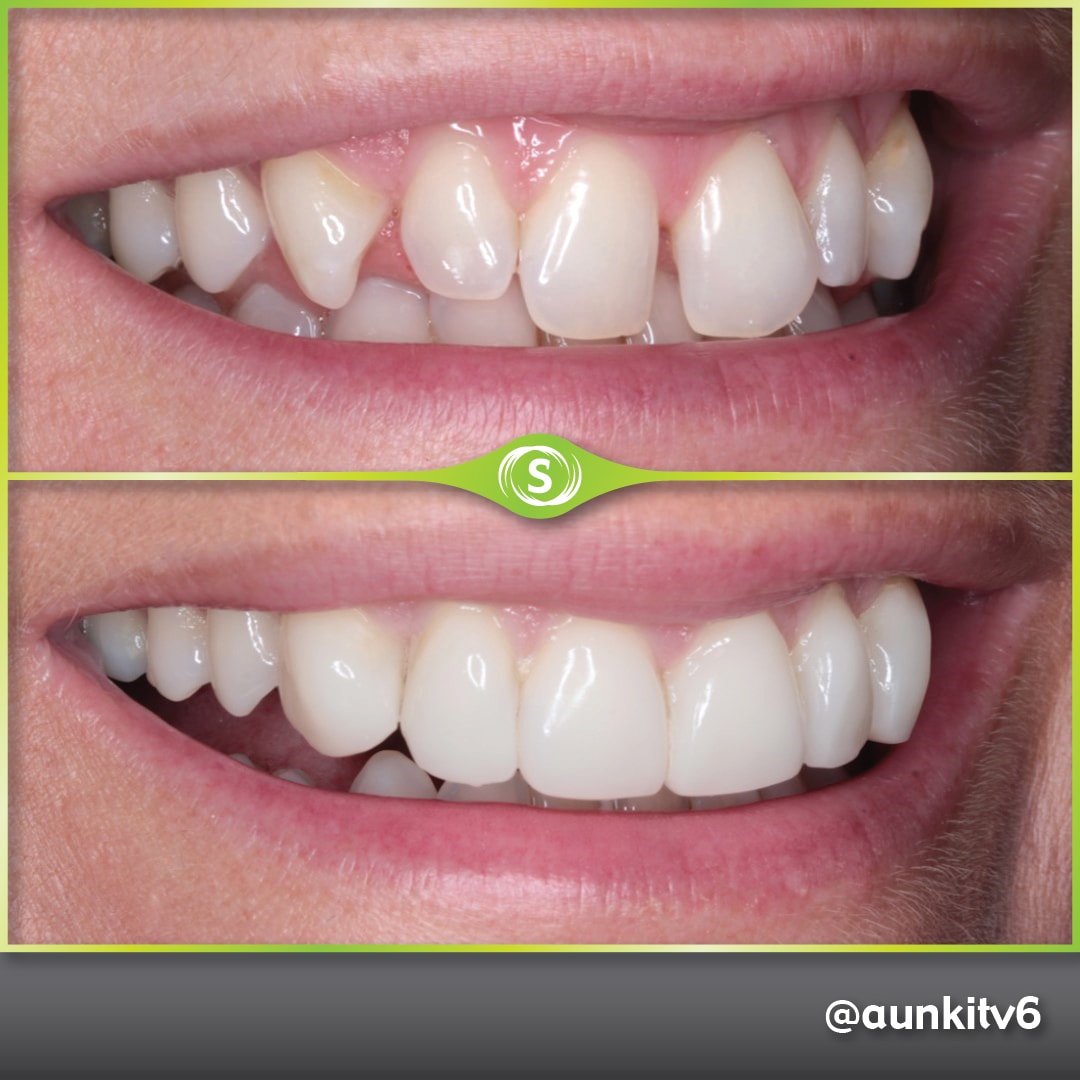 Composite Bonding Case 888 - Dr. Aunkit Vaja