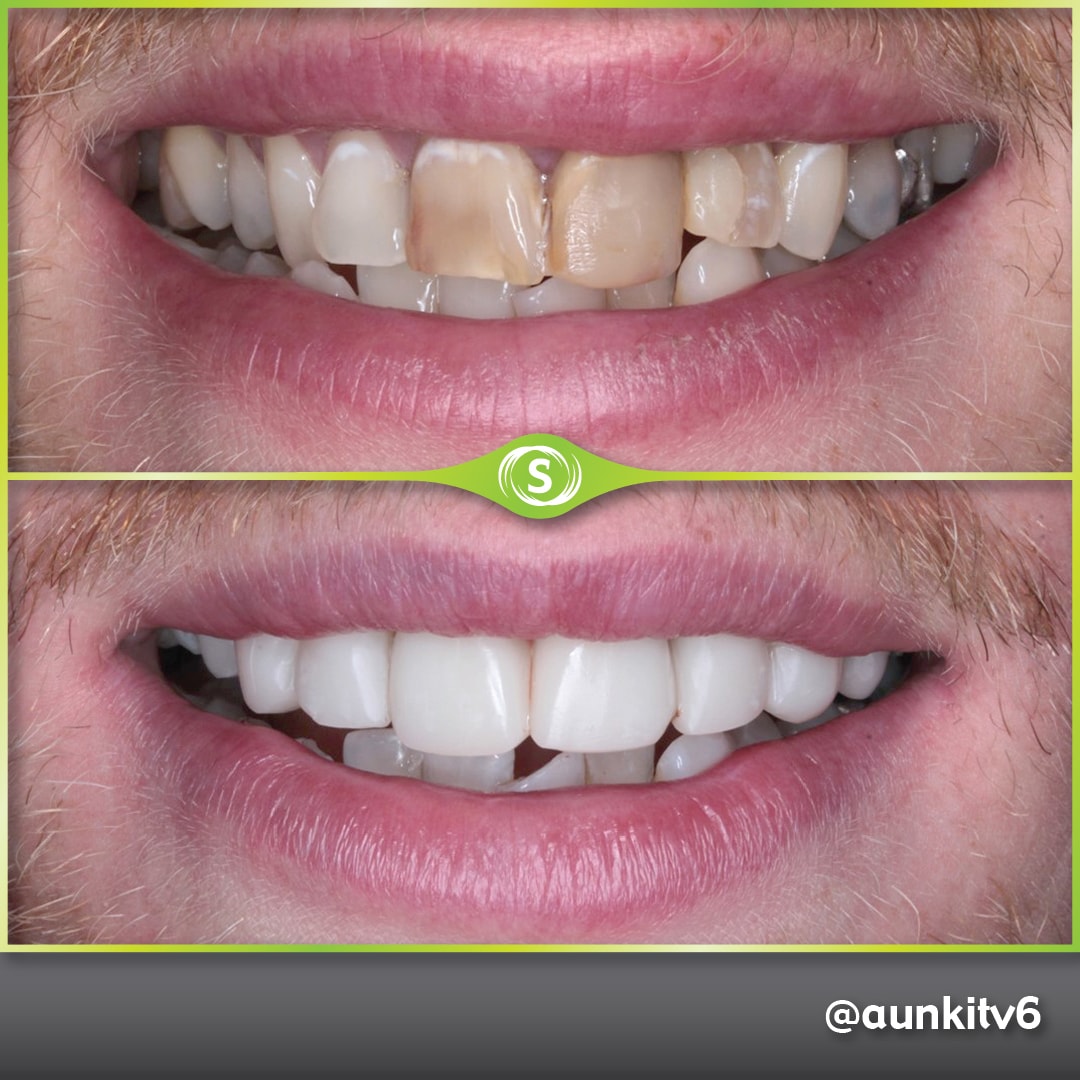 Composite Bonding - Dr. Aunkit Vaja