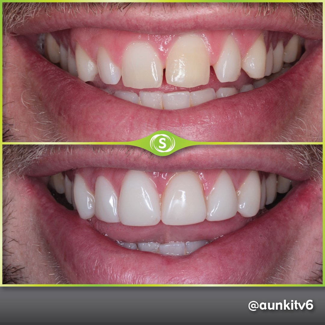 Composite Bonding - Dr. Aunkit Vaja