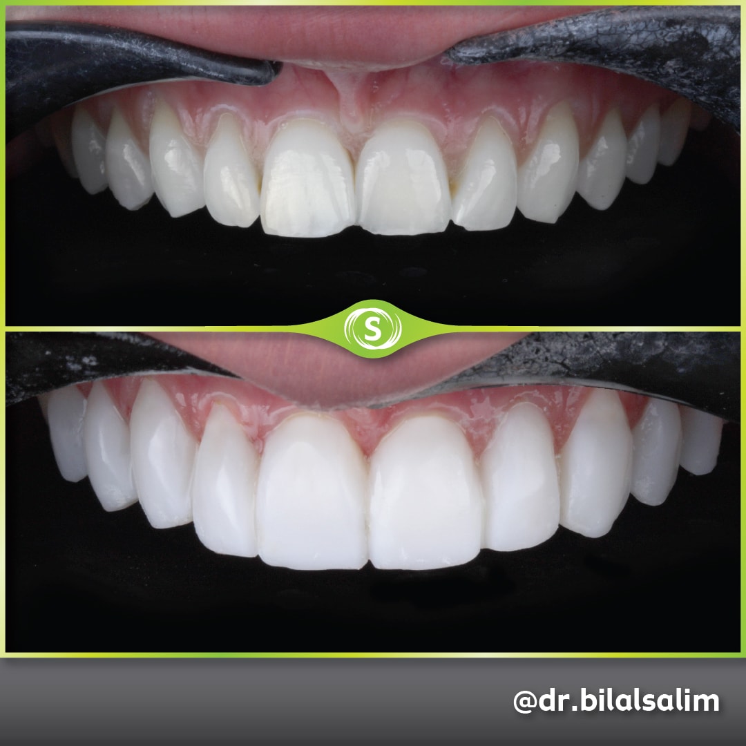 Composite Bonding - Dr. Bilal Salim
